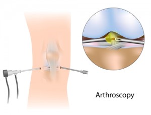 Arthroscopic Knee Surgery in Los Angeles, CA