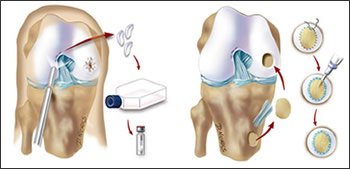 proc_img_cartilage06