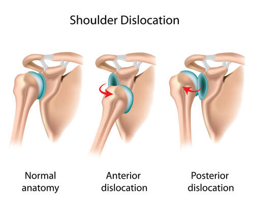 Shoulder Dislocation Treatment, Los Angeles, CA