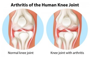 Arthritis Treatment in Los Angeles, CA