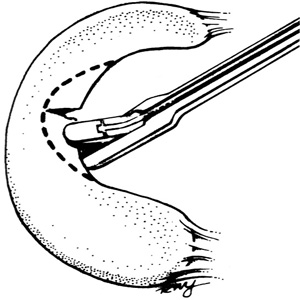 Fig3Meniscus1