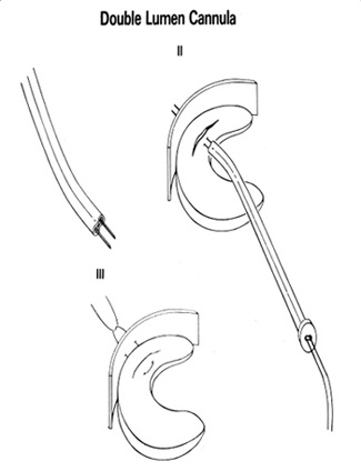 Fig4Meniscus2