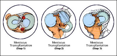 proc_img_menistrans