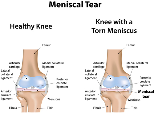 Treatment for a Torn Meniscus, Los Angeles, CA