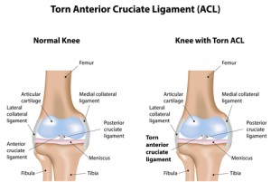 Diagram of an ACL Tear