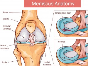 Illustration of Meniscus Tear Surgery