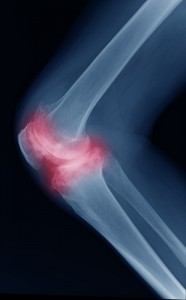 Osteoarthritis Knee